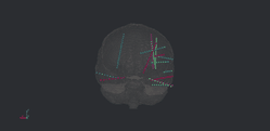 Electrodes on brain
