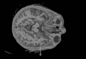 Oblique + CT
