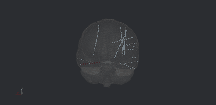 SEEG electrodes in 3D